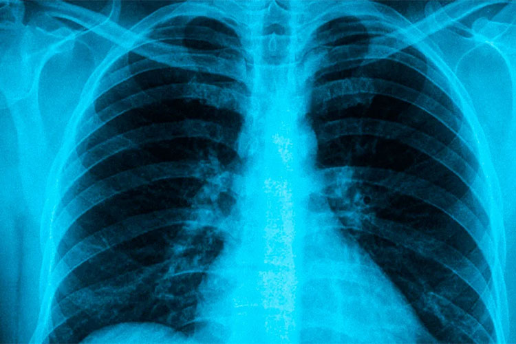 YOLO胸部X光片检测与高质量图像数据集