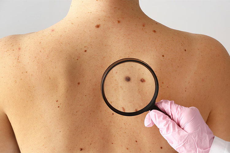 基于YOLO格式的皮肤病目标检测数据集