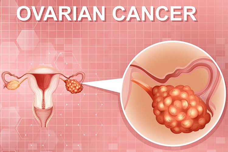 基于YOLOv8深度学习的医学影像卵巢癌自动检测系统(PyQt5界面+数据集+训练代码)