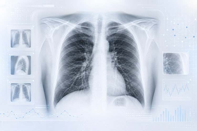 胸部X光(CXR)数据集