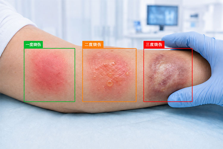 基于YOLO皮肤烧伤数据集：该数据集包含标注了不同程度皮肤烧伤的图像